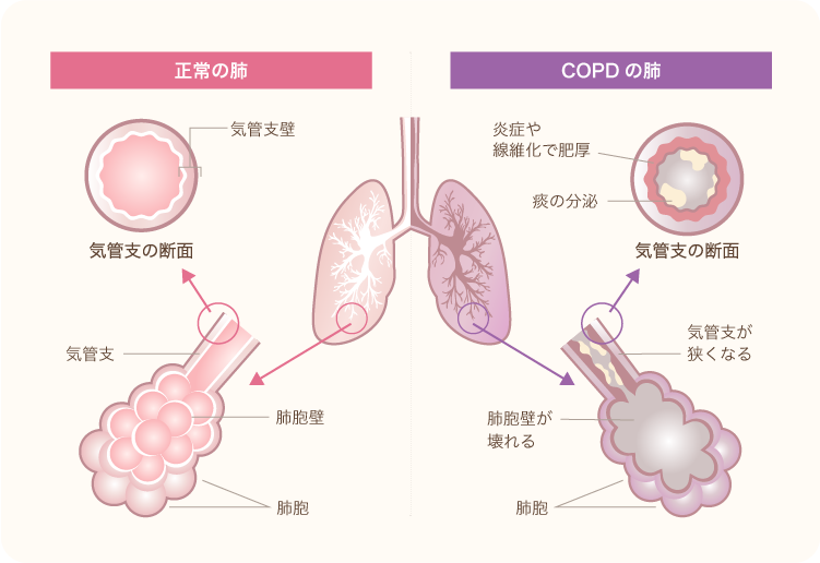 正常の肺　COPD（肺気腫）の肺